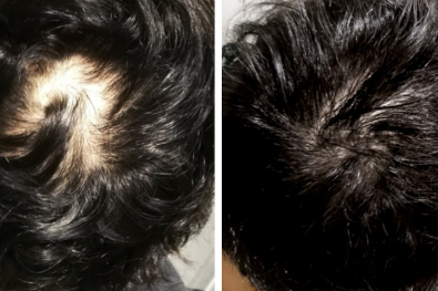 hair loss treatment men before and after HR23+