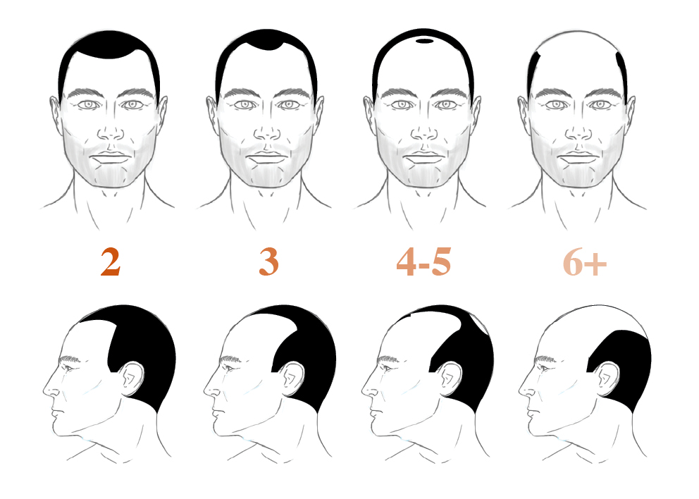 hair loss stages 