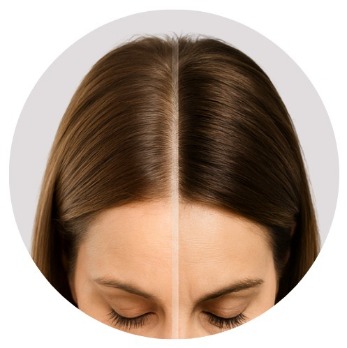 HR23+ hair loss treatment for women before and after shot