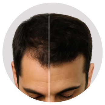 HR23+ hair loss treatment for men reviews before and after photo