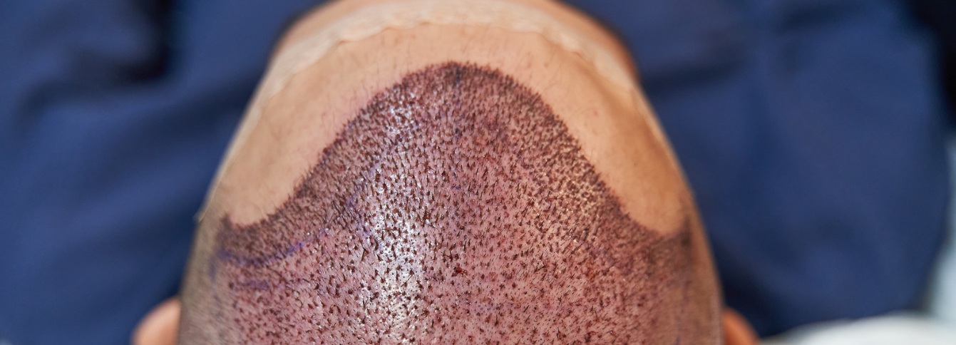 Hair transplant aftercare and recovery advice