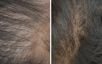 hair loss before and after treatment HR23+