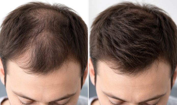 Before and after male hair growth results using HR23+