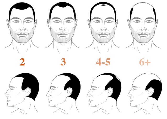 Norwood Hamilton Scale for Hair Loss | Measuring Male Pattern Baldness with  the Norwood Hair Scale