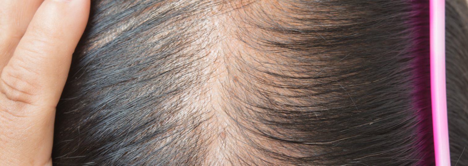 Thinning scalp and ways to stop hair loss