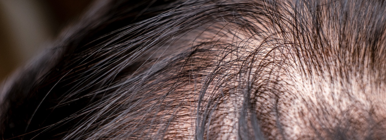 Is there a cure for hair loss? Hair loss treatments and regrowth explained